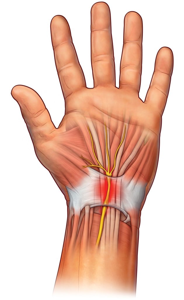 Karpalni Tunel Chirurgie Ruky Ic Klinika Brno