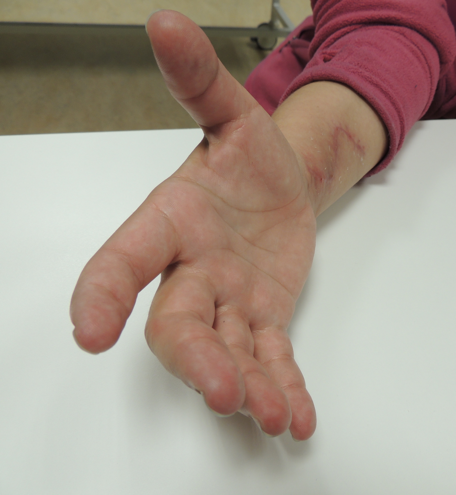Chirurgické uvolnění srůstů šlach ruky